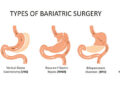 gastric bypass surgery