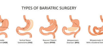 gastric bypass surgery
