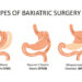 gastric bypass surgery