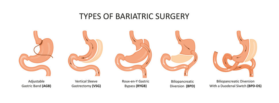 Pros And Cons Of Gastric Bypass Surgery What To Consider When Deciding If Surgery Is Right For