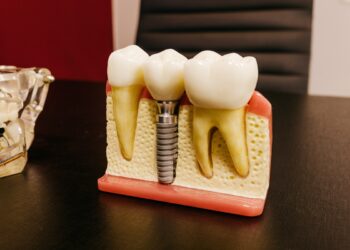dental implant