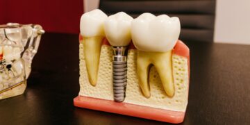 dental implant