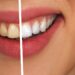 dental bonding